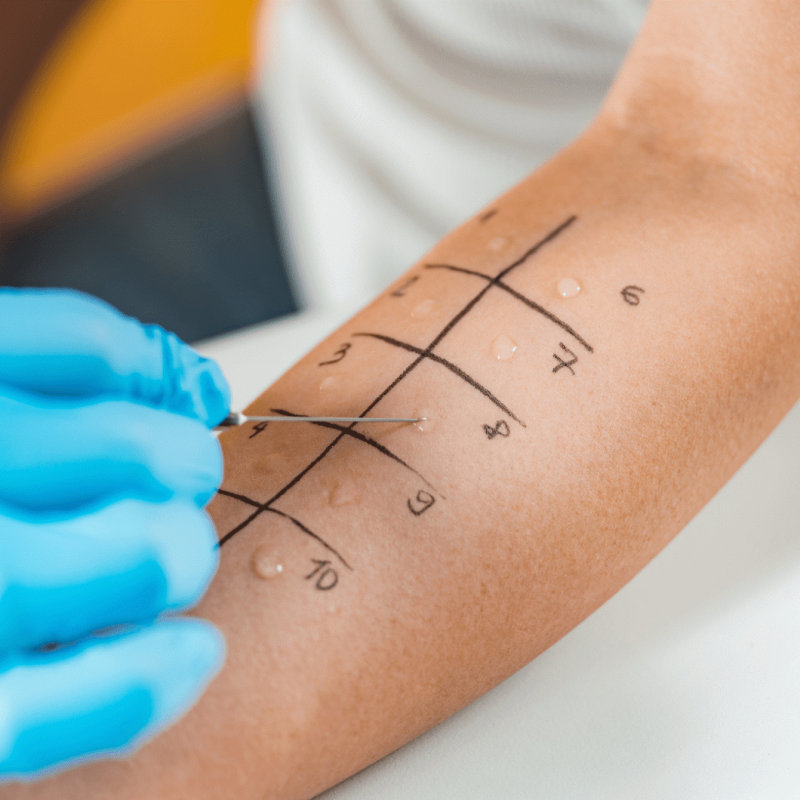 Allergy Testing Dublin
